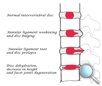 intervertebral disc