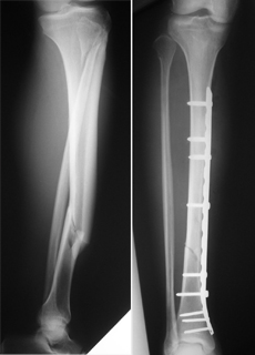 X-ray demonstrate the pre-fracture; X- ray demonstrate fracture surgery 